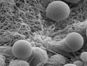 انتبه.. طولك يؤثر على فرص الإصابة بالجلطات الدموية