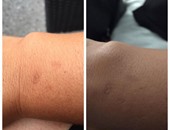 ساعة أبل الذكية تتسبب فى حروق جلدية للمستخدمين