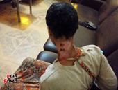 رئيس جامعة سوهاج يكلف أستاذ جراحة تجميل بتولى حالة "حياة" ضحية التعذيب 