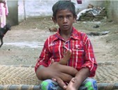 بالفيديو والصور.. مرض نادر يتسبب فى زيادة وزن يد طفل هندى إلى 13 كيلو