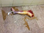 مستشفى الإسكندرية الجامعى يفتح تحقيقا فى واقعة نشر صورة الساق المبتورة