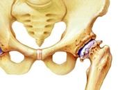 إصابات مفصل الفخذ الأكثر انتشارًا بين كبار السن بسبب هشاشة العظام
