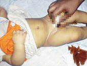 وفاة طفلة فى السويس خلال عملية ختان والنيابة تحيلها للطب الشرعى