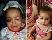 "صحافة المواطن": قارئ يطالب بعلاج طفلة أصيبت برصاصة أدت لكسر جمجمتها