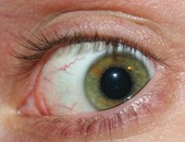 ابتكار جهاز جديد لعلاج جفاف العين يعمل بالوايرلس