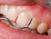 دكتور أسنان: يمكن الحفاظ على أسنان الأطفال بدون اعوجاج بخطوات بسيطة