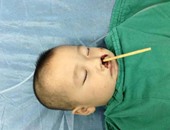 جراحة نادرة لرضيع صينى بعد اختراق عيدان الأكل دماغه