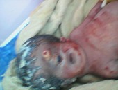 بالصور.. ولادة طفل بعين واحدة وأنف مسمار داخل مستشفى ببنى سويف