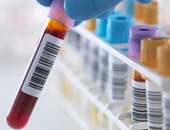 باحثون أستراليون يتوصلون لتحليل دم جديد لسرعة تشخيص السرطان