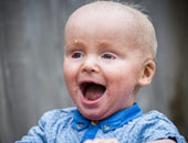 بالصور.. طفل بريطانى يعانى من مرض جلدى نادر يشبه قشور السمك