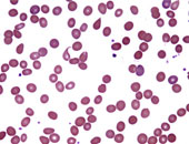 علماء أمريكيون: اختبار جديد لفقر الدم المنجلى لإنقاذ آلاف الأطفال