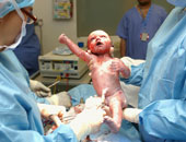 أطباء ينصحون بولادة المرأة طبيعيا بعد حالتى ولادة قيصرية