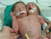 فصل توأم ملتصق عن أخر ميت فى إسرائيل