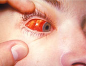 فيروس أو بكتيريا وراء الإصابة بالتهاب ملتحمة العين