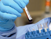 باحثون فرنسيون: أمل جديد فى علاج فقر الدم المسبب للأنيميا الوراثية الحادة