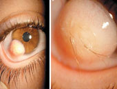 "المصرية للشبكية" تعلن اعتماد علاج جديد لمرض اعتلال الشبكية السكرى 