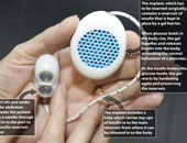 وداعاً لحقن الأنسولين.. جهاز مبتكر يُزرع بالبطن للسيطرة على سكر الدم