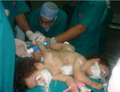 بالصور.. فصل التوأم الملتصق "روان وريدا" بمستشفى الأطفال ببنها 