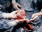 حصى الكلى.. العطش بيت الداء والماء الوقاية