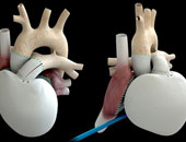 هبوط عضلة القلب يستدعى الجراحة وزرع منظم للقلب