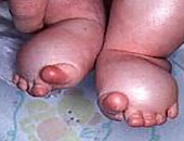 ما أعراض متلازمة "تيرنر"؟