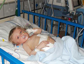 مرض الصفراء يحدث نتيجة تراكم البيليروبين لدى الطفل