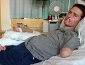 بالصور.. رجل بريطانى أصيب بنزلة برد كلفته فقدان ثلاثة من أطرافه