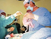 دراسة طبية: 5 عمليات ولادة قيصرية متتالية تهدد حياة المرأة وتعرضها لمضاعفات خطيرة