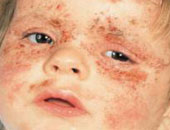 اسباب التهاب الجلد والأطعمة والمواد التى تزيد مشكلاته 