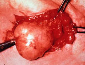 استئصال ورم ليفى كبير من رحم طفلة بأسوان بدون تدخل جراحى