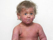 تعرف على الأطعمة التى تسبب الحساسية للأطفال