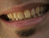 ما علاج اصفرار الأسنان بالأعشاب الطبيعية؟