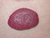 كيف يمكن علاج الوحمات الدموية عند الأطفال؟