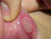 تعرف على أسباب ظهور قرح الفم وطرق علاجها