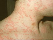 ما علاج الأرتيكاريا المزمنة؟