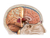 اعراض الإصابة بأورام المخ أبرزها التغيرات فى الذاكرة والتفكير