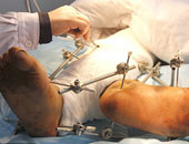 جراح عظام:التحميل على عضلات الساقين لفترات طويلة يسبب الكسر الإجهادى