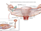 محكمة إسرائيلية توافق على تجميد بويضات فتاة أصيبت بموت الدماغ