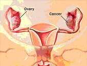 أدوية علاج سرطان الثدى تؤدى إلى الإصابة بسرطان بطانة الرحم