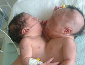 السعودية تعلن نجاح عملية فصل التوأم السيامى (عبدالله وسلمان) 