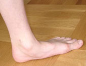 مشكلة الفلات فوت وعلاجها بأسهل الطرق