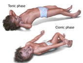 الأمهات اللاتى يعانين السمنة أكثر عرضة لولادة أطفال مصابين بالصرع