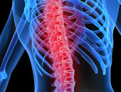 هل خشونة الفقرات العنقية تسبب تنميل الكتف والذراع؟
