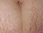 ما علاج تشققات الجلد البيضاء؟