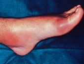 تورم القدمين عند التعرض لصدمة ليس دليلا على الإصابة بالكسر