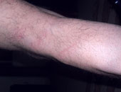 ما الجروح السطحية؟ وما طرق علاجها؟