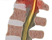 ما ابيضاض الدم النخاعى الحاد؟