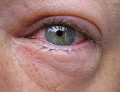 أخصائية عيون تنصح بـ5 طرق لعلاج انتفاخ العينين
