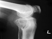 مستشفي الهرم يؤهل شباب الأطباء على استخدام جراحات مناظير الركبة