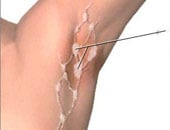 تعرف على أسباب تورم الغدد الليمفاوية.. السل الرئوى والحصبة أبرزها